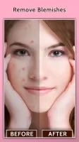 Face Blemish Remover - Smooth